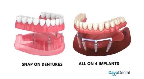 Are snap-in dentures covered by insurance