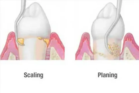 Scaling and root planing cost with insurance