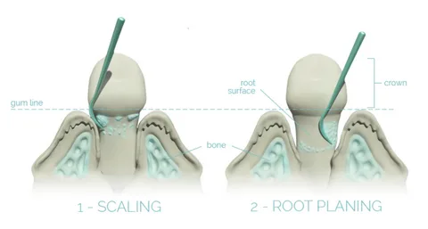 Scaling and root planing cost with insurance